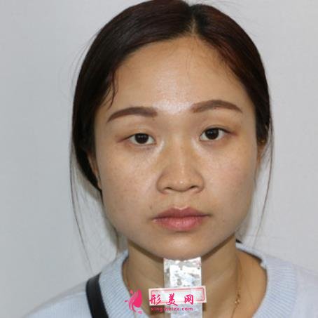 深圳北大醫(yī)院整形科做雙眼皮怎么樣？案例及價(jià)格表（多少錢）在線參考