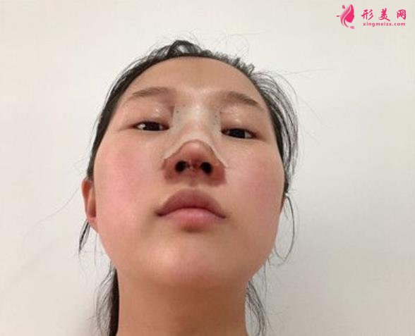 溫州藝星整形美容醫(yī)院做隆鼻怎么樣？好不好？專家案例價(jià)格收費(fèi)一覽