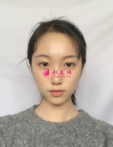 云南省中醫(yī)院美容科怎么樣?看專家顴骨案例及部分項目價格表收費明細