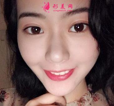 空軍總醫(yī)院雙眼皮怎么樣？專家案例效果分享_手術(shù)費(fèi)用在線查詢