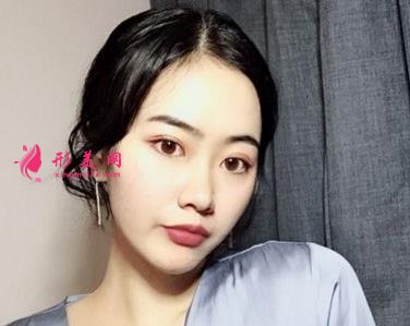 空軍總醫(yī)院雙眼皮怎么樣？專家案例效果分享_手術(shù)費(fèi)用在線查詢