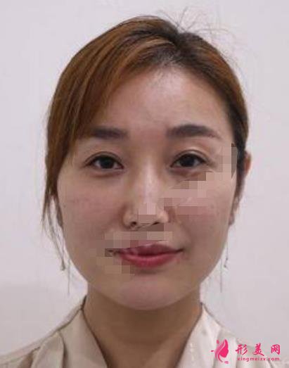衡水整形醫(yī)院哪家好？排名前三口碑推薦_含除皺（頸紋）案例效果圖