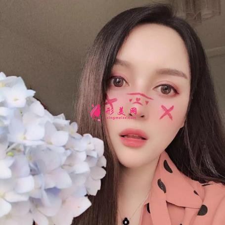 杭州美萊高士乾做的鼻子怎么樣？2021隆鼻案例+價格表曝光