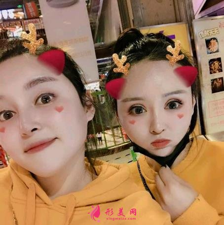 杭州美萊高士乾做的鼻子怎么樣？2021隆鼻案例+價格表曝光