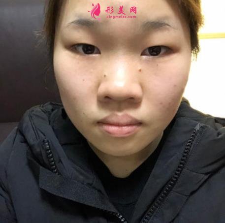 濟南千佛山醫(yī)院整形科怎么樣？附雙眼皮恢復過程圖一覽