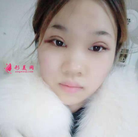 濟南千佛山醫(yī)院整形科怎么樣？附雙眼皮恢復過程圖一覽