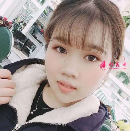濟南千佛山醫(yī)院整形科怎么樣？附雙眼皮恢復過程圖一覽