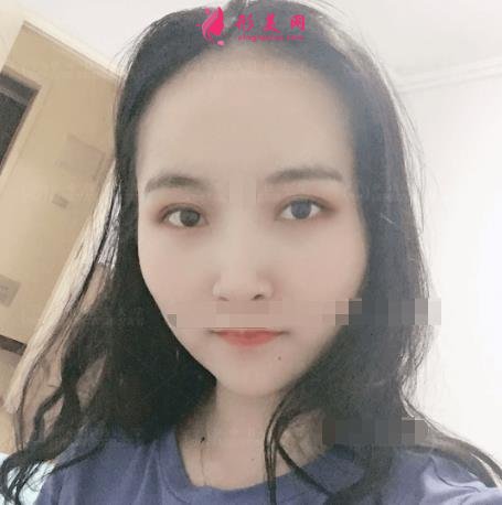 濟(jì)南中心醫(yī)院整形科怎么樣？附雙眼皮價格披露及案例效果一覽