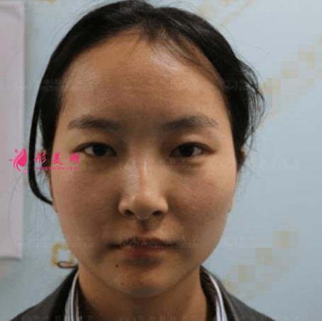 濟(jì)南中心醫(yī)院整形科怎么樣？附雙眼皮價格披露及案例效果一覽
