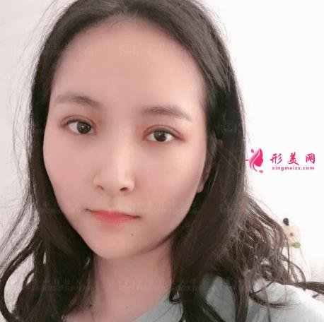 濟(jì)南中心醫(yī)院整形科怎么樣？附雙眼皮價格披露及案例效果一覽