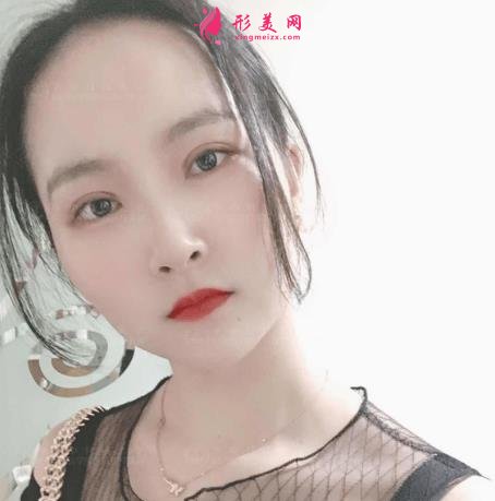 濟(jì)南中心醫(yī)院整形科怎么樣？附雙眼皮價格披露及案例效果一覽