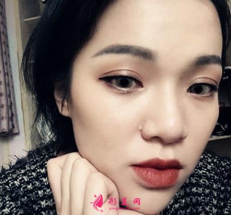 嘉興第一人民醫(yī)院整形科怎么樣?做雙眼皮案例效果圖和價(jià)格表展示
