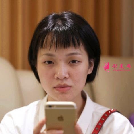 嘉興第一人民醫(yī)院整形科怎么樣?做雙眼皮案例效果圖和價(jià)格表展示