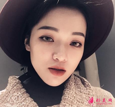 嘉興第一人民醫(yī)院整形科怎么樣?做雙眼皮案例效果圖和價(jià)格表展示