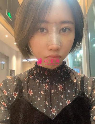 廣州海峽整形醫(yī)院隆鼻好嗎？顧客口碑和精選案例在線(xiàn)查看