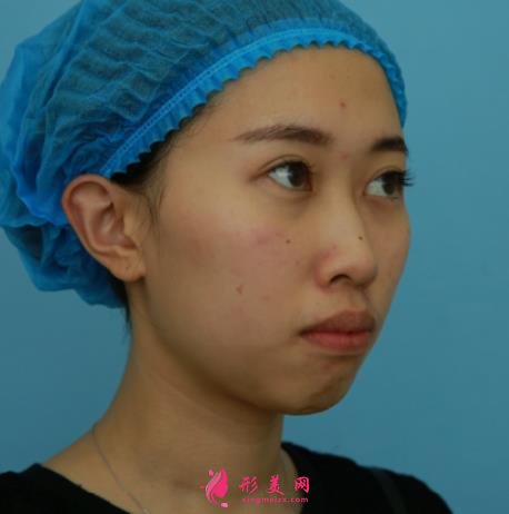 廣州海峽整形醫(yī)院隆鼻好嗎？顧客口碑和精選案例在線(xiàn)查看