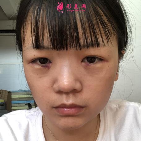 浙江省中醫(yī)院車菲掛號容易嗎?去眼袋多少錢？附案例參考
