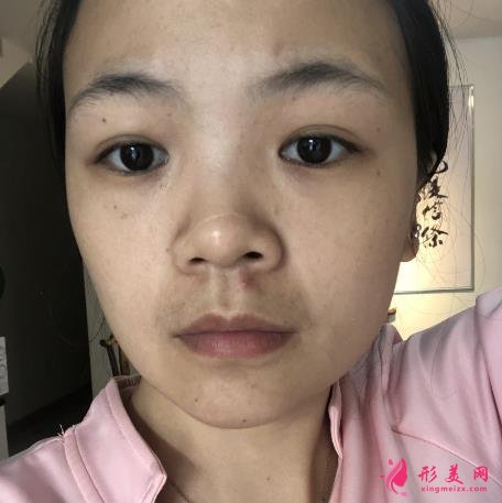 浙江省中醫(yī)院車菲掛號容易嗎?去眼袋多少錢？附案例參考