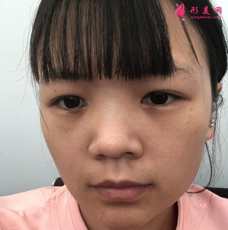 浙江省中醫(yī)院車菲掛號容易嗎?去眼袋多少錢？附案例參考