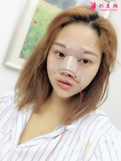 北京藝星和北京壹加壹做鼻子哪家好？了解一下案例和隆鼻醫(yī)生技術(shù)特點(diǎn)