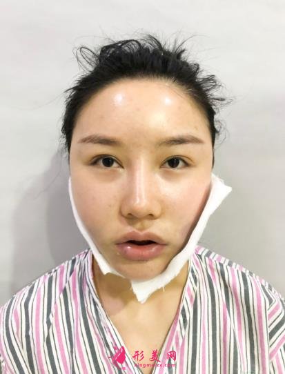 成都排名第一的整容醫(yī)院是誰？對比華西口腔李繼華磨骨案例怎么樣？