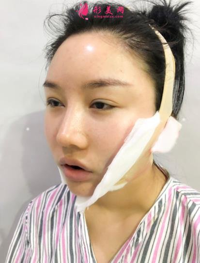 成都排名第一的整容醫(yī)院是誰？對比華西口腔李繼華磨骨案例怎么樣？