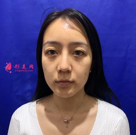 西安熱瑪吉五代哪里可以做？西京醫(yī)院整形案例和費(fèi)用多少
