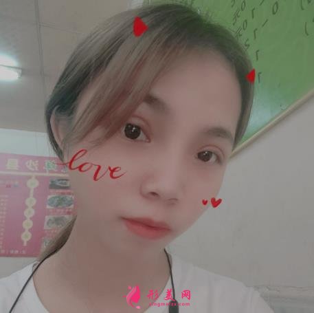北京電力醫(yī)院整形中心價(jià)格表及雙眼皮手術(shù)恢復(fù)過程分享