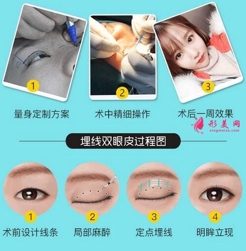 汕頭曙光整形醫(yī)院雙眼皮案例