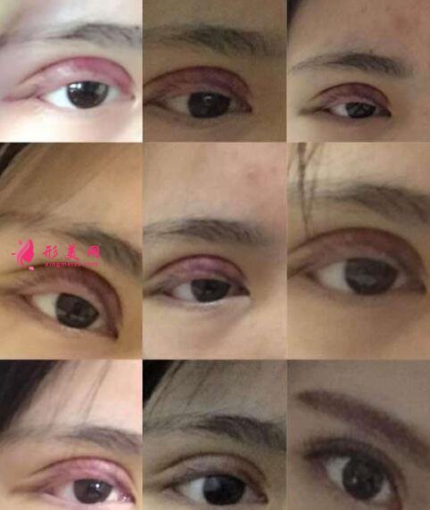 武漢161醫(yī)院整形外科雙眼皮案例圖