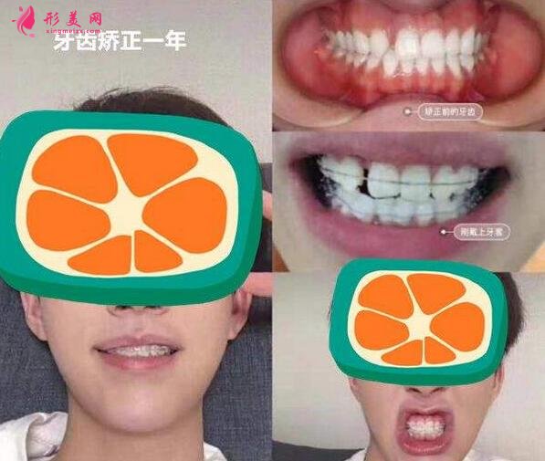 口腔科牙齒矯正案例
