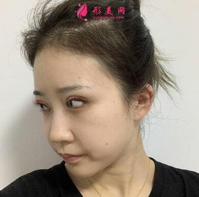 北京協(xié)和醫(yī)院整形科割雙眼皮怎么樣?案例效果和價(jià)格表費(fèi)用分享