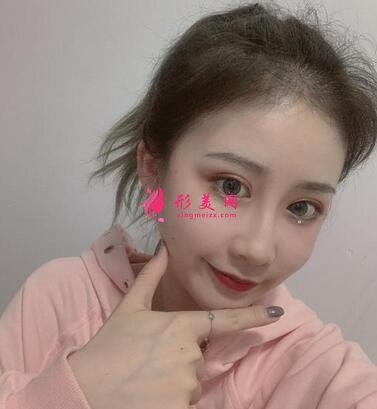 北京協(xié)和醫(yī)院整形科割雙眼皮怎么樣?案例效果和價(jià)格表費(fèi)用分享