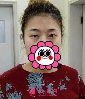 唐山金榮是三甲醫(yī)院嗎?雙眼皮案例及價格表一覽！