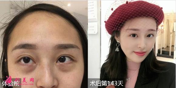 暨南大學(xué)附屬第一醫(yī)院整形科價(jià)格表_醫(yī)生簡(jiǎn)介_祛眼袋案例一覽