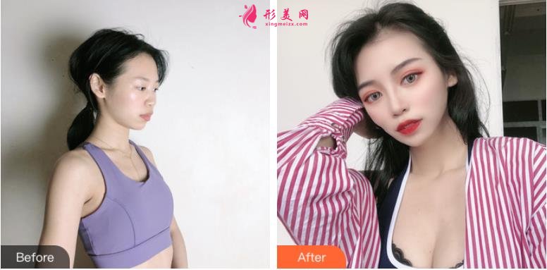 吉大一院自體脂肪填充整形價(jià)格表公開，附隆胸案例效果圖
