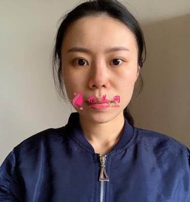 沈陽(yáng)軍區(qū)總醫(yī)院整形科醫(yī)生名單簡(jiǎn)介，附隆鼻案例