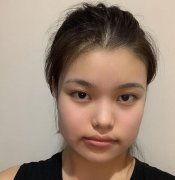 北京中日友好醫(yī)院整形外科磨骨案例分享，附價(jià)格表新版費(fèi)用