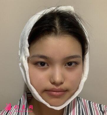 北京中日友好醫(yī)院整形外科磨骨案例分享，附價格表新版費用