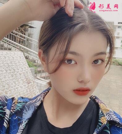 北京中日友好醫(yī)院整形外科磨骨案例分享，附價格表新版費用