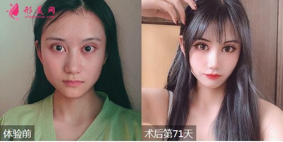 深圳富華醫(yī)院整形價格表一覽！有隆鼻效果為大家展示！
