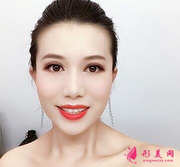 廣州中科美整形醫(yī)院價格表費用和雙眼皮效果對比圖分享~