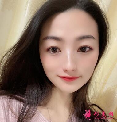 邯鄲市第四醫(yī)院整形科價(jià)格表收費(fèi)|雙眼皮案例圖賞析~