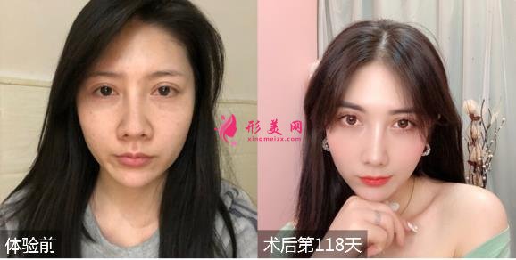 北京沃爾劉彥軍醫(yī)生隆鼻怎么樣？專家案例及價格表出爐！