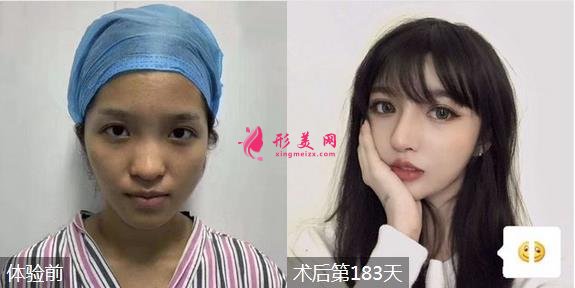 北京沃爾劉彥軍醫(yī)生隆鼻怎么樣？專家案例及價格表出爐！