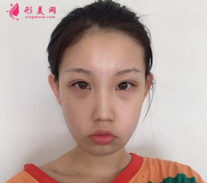 深圳市人民醫(yī)院整形美容科價格表隆鼻整形案例分享