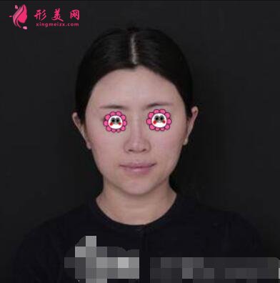 鄭大一附院整形外科隆鼻咋樣?案例效果和價格費用一覽