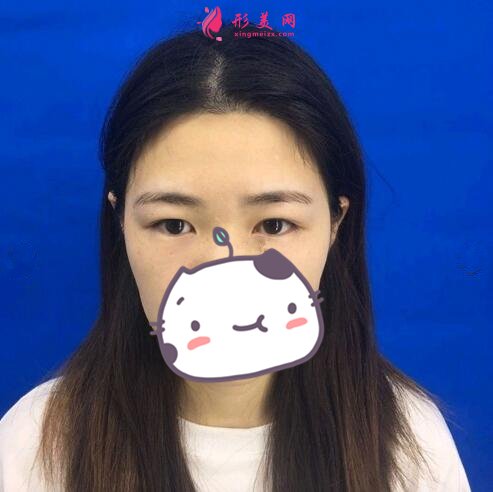 河北友愛(ài)醫(yī)院整形美容科何靜做雙眼皮案例價(jià)格表收費(fèi)一覽