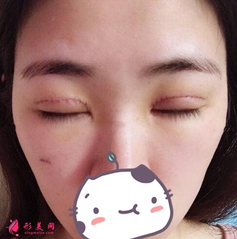 河北友愛(ài)醫(yī)院整形美容科何靜做雙眼皮案例價(jià)格表收費(fèi)一覽