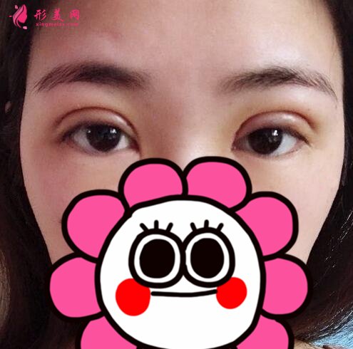 河北友愛(ài)醫(yī)院整形美容科何靜做雙眼皮案例價(jià)格表收費(fèi)一覽
